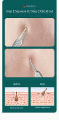 Acne Remover Needles