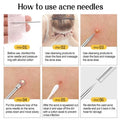 Acne Needle
