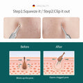 Acne Remover Needles