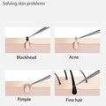 Acne Needle
