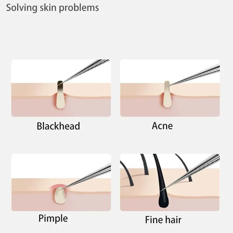 Acne Needle