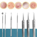 Acne Needle