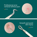 Acne Remover Needles